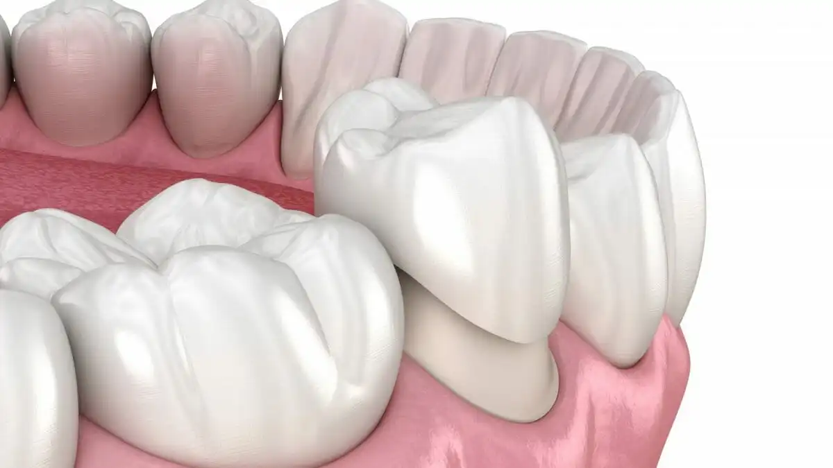 Ceramic Crowns & Bridges