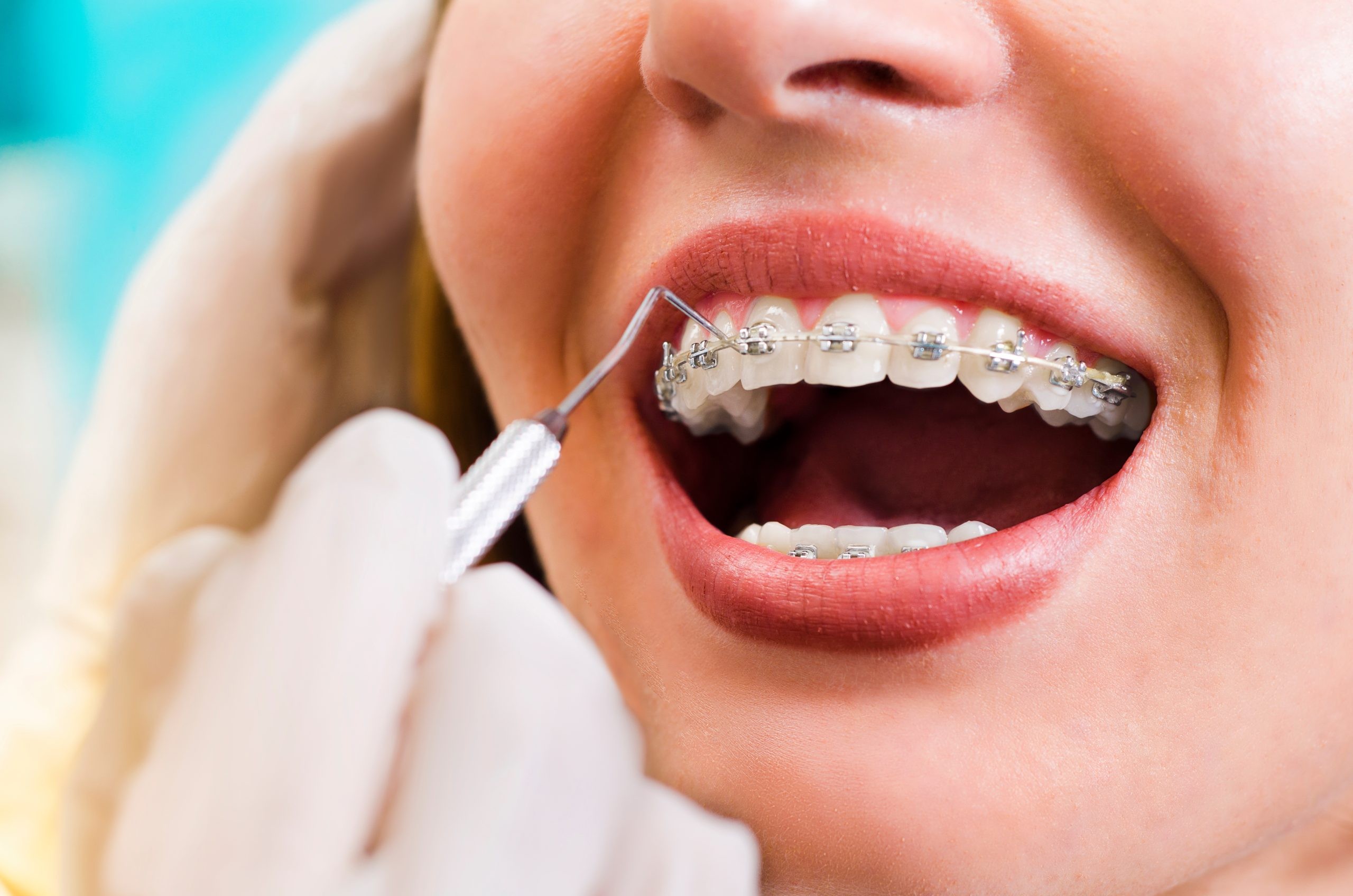 Orthodontic Braces