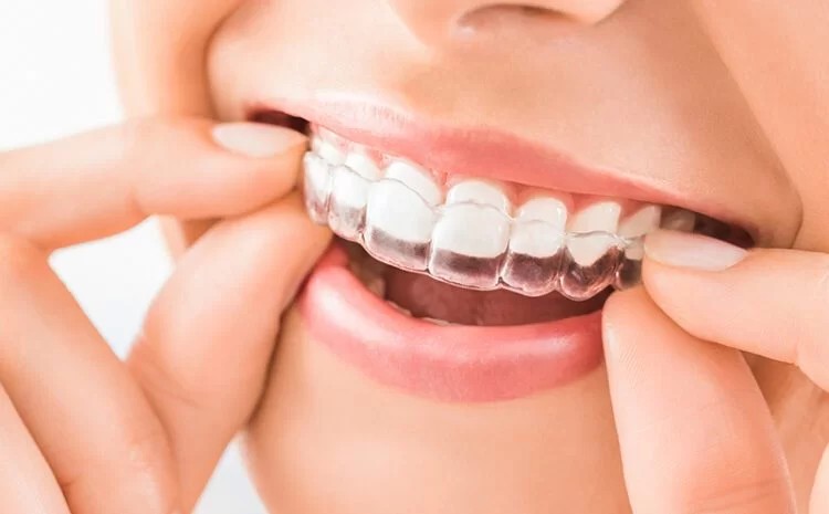Dental Aligners
