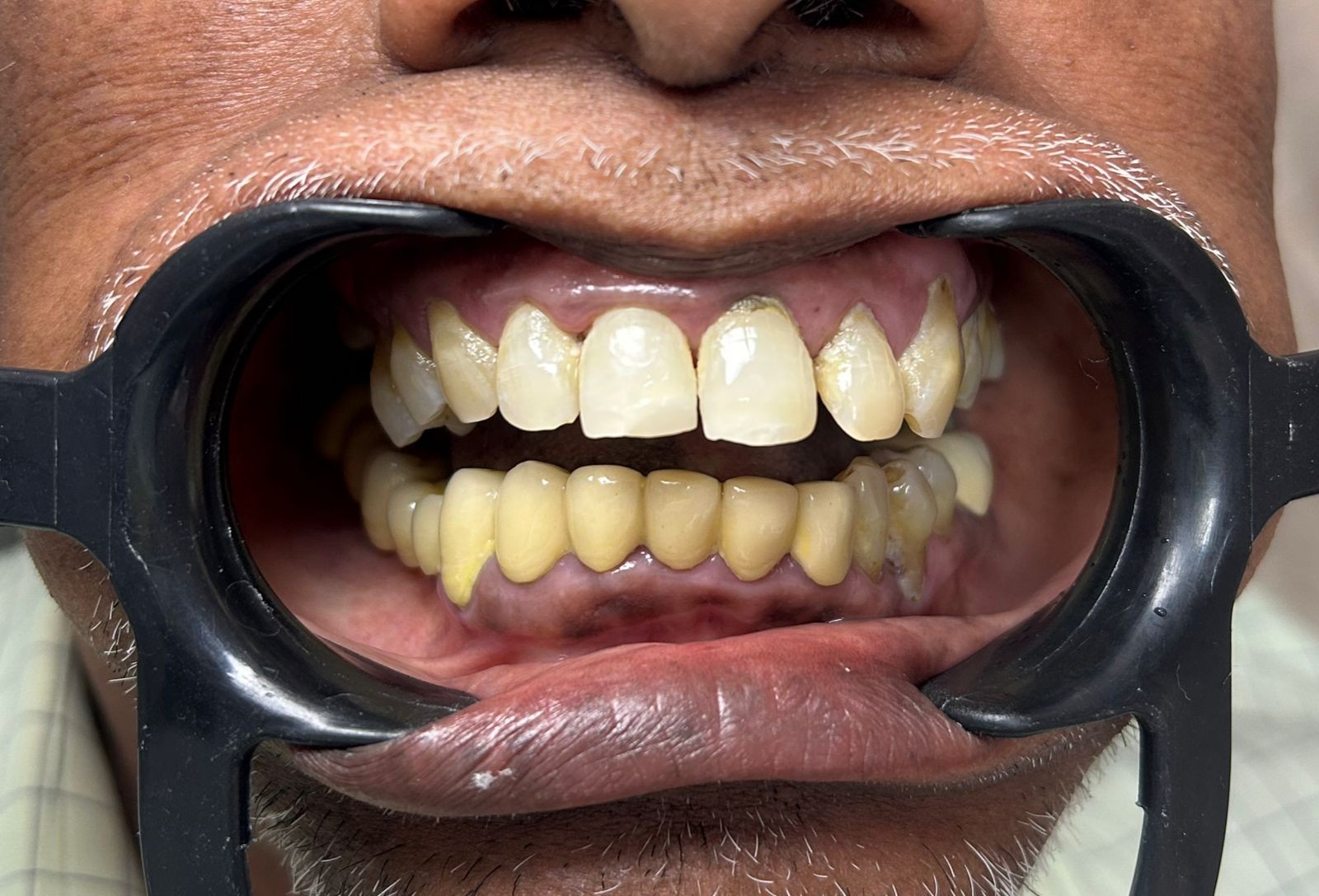 Before smile transformation 2