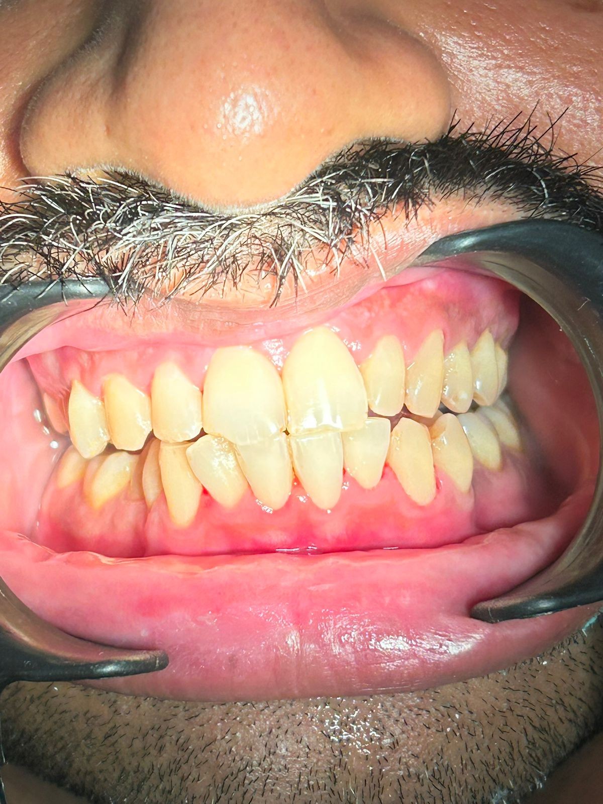 Before smile transformation 3