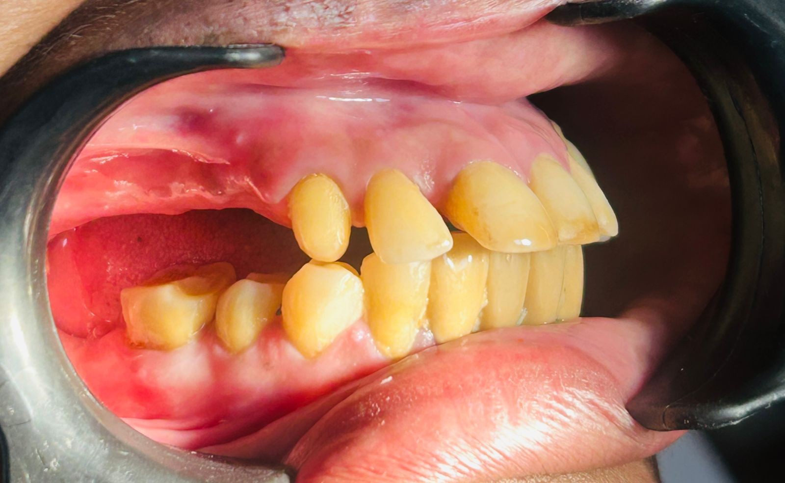 After smile transformation 5