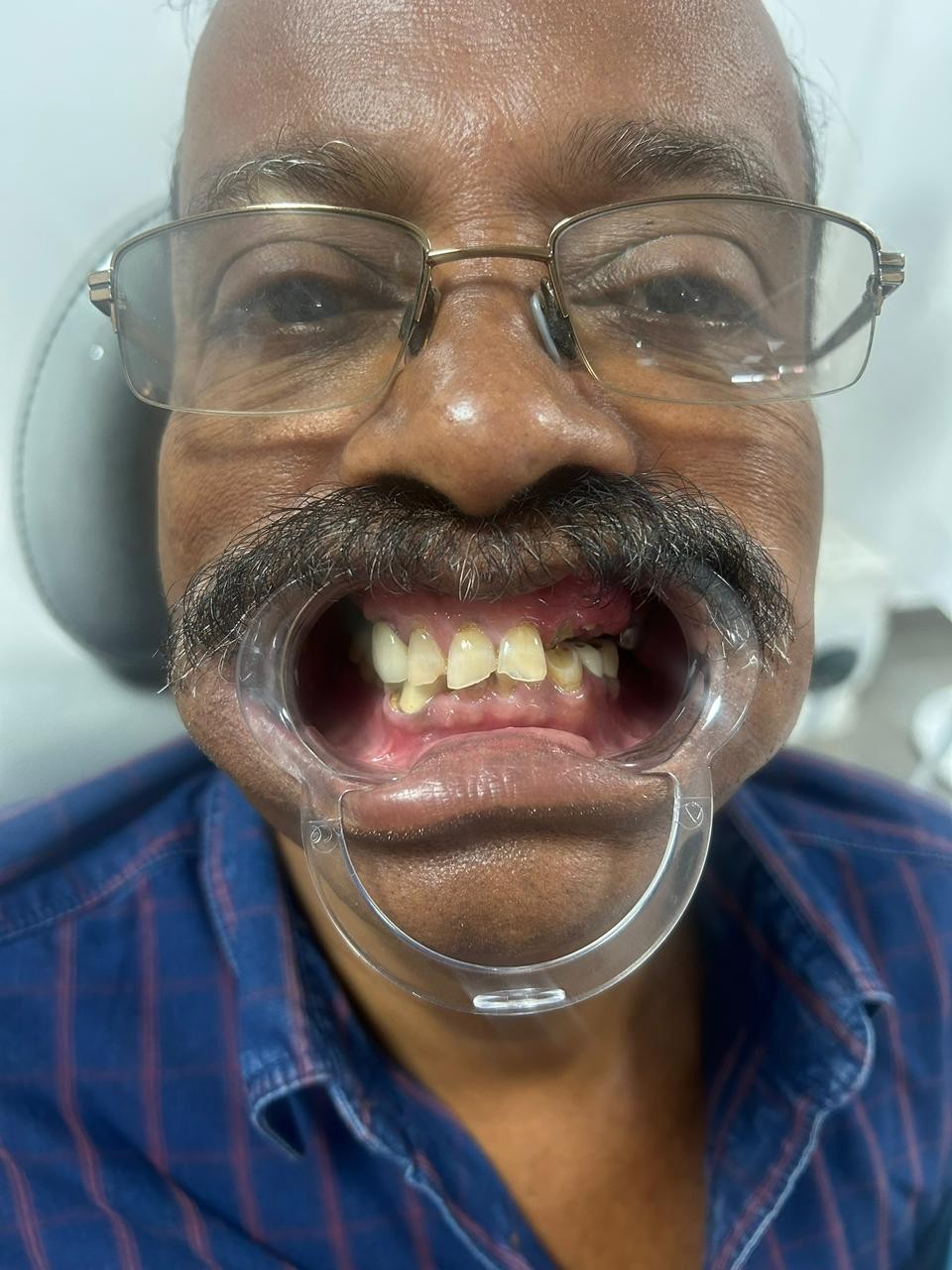After smile transformation 6