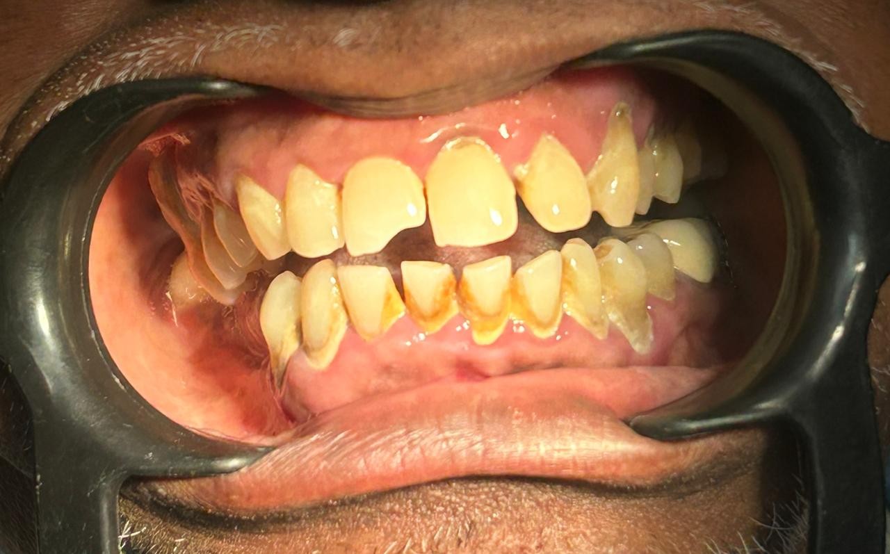 After smile transformation 7