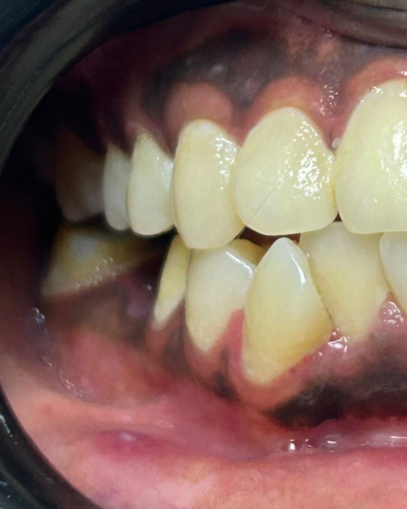After smile transformation 8