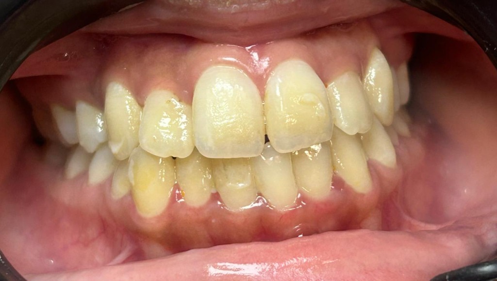 After smile transformation 9
