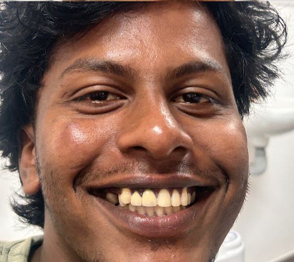 Before smile transformation 1