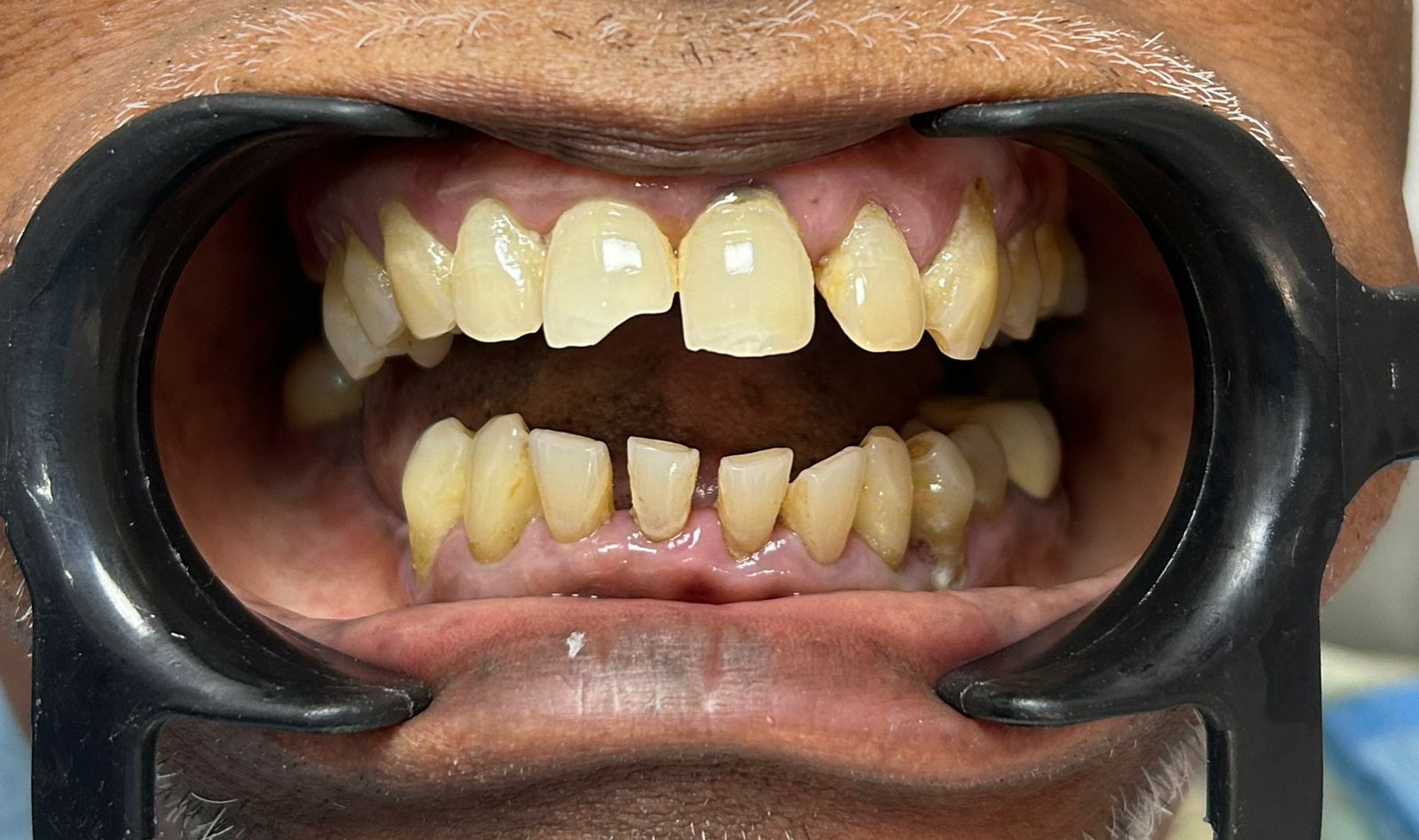 After smile transformation 2