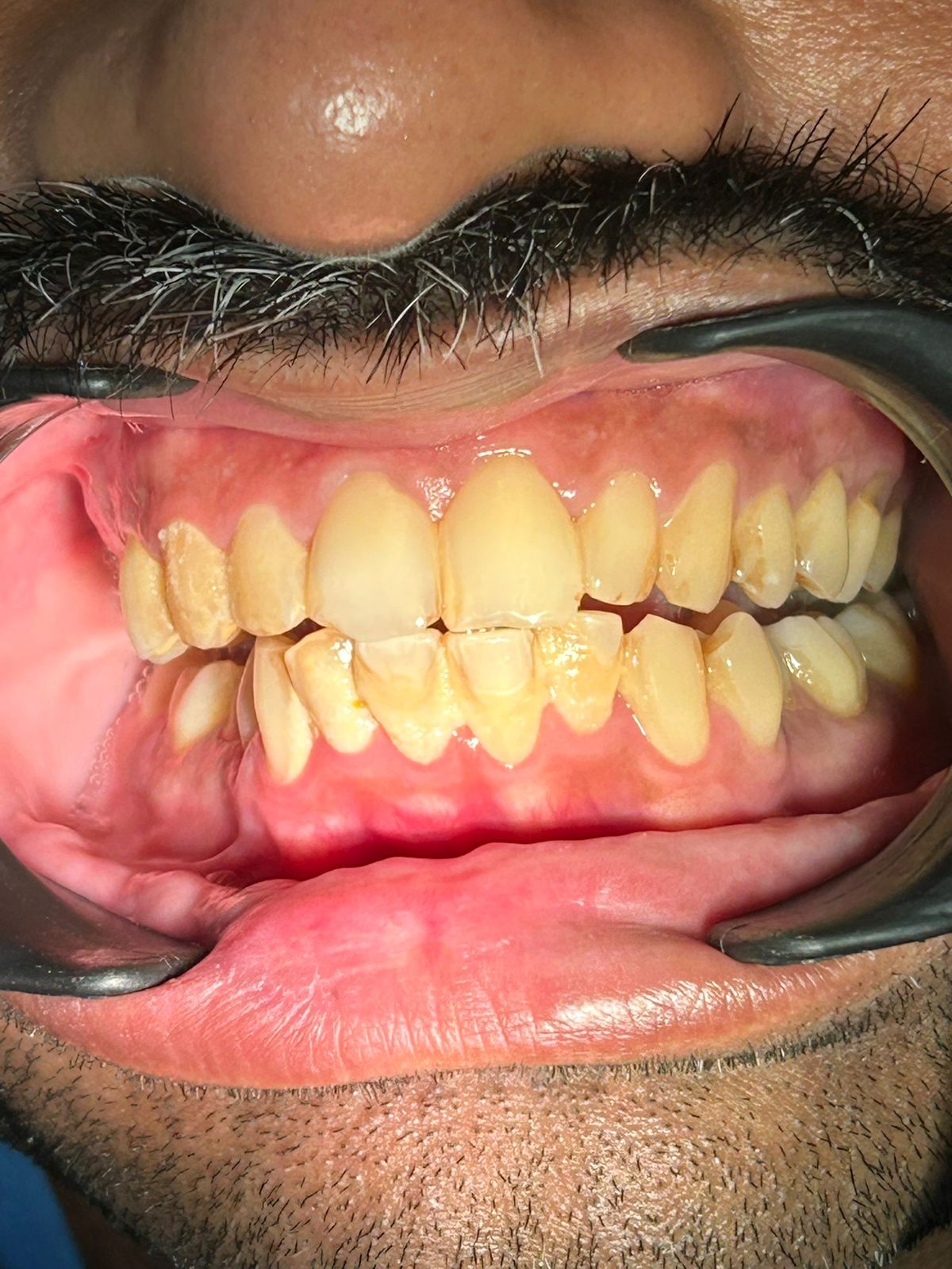 After smile transformation 3
