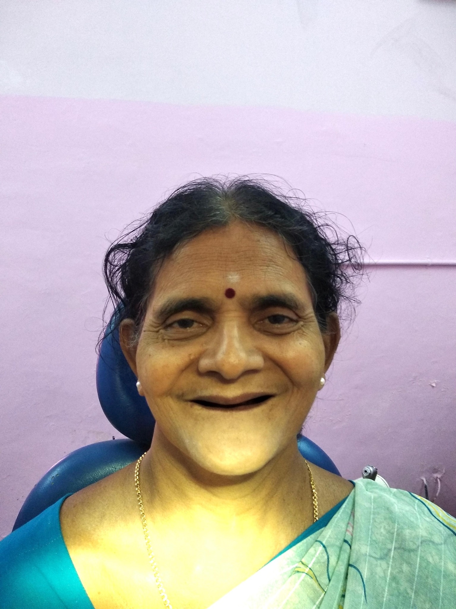 Before smile transformation 4