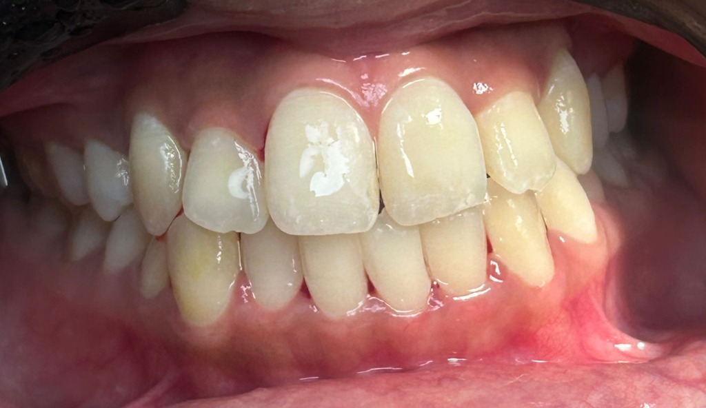 Before smile transformation 9